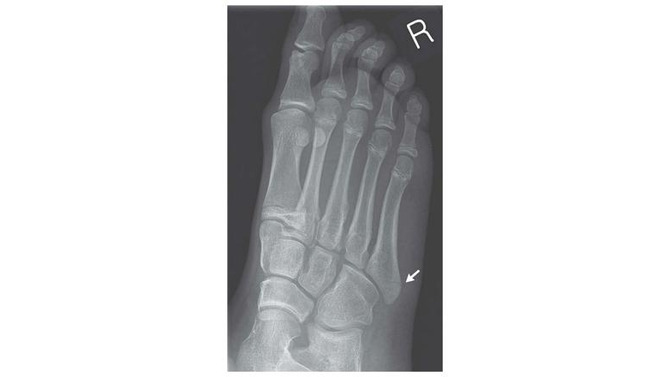 14歳の少女がバランスWiiボードで足を折る－「従来のゲーム機より怪我する率が高く見える」